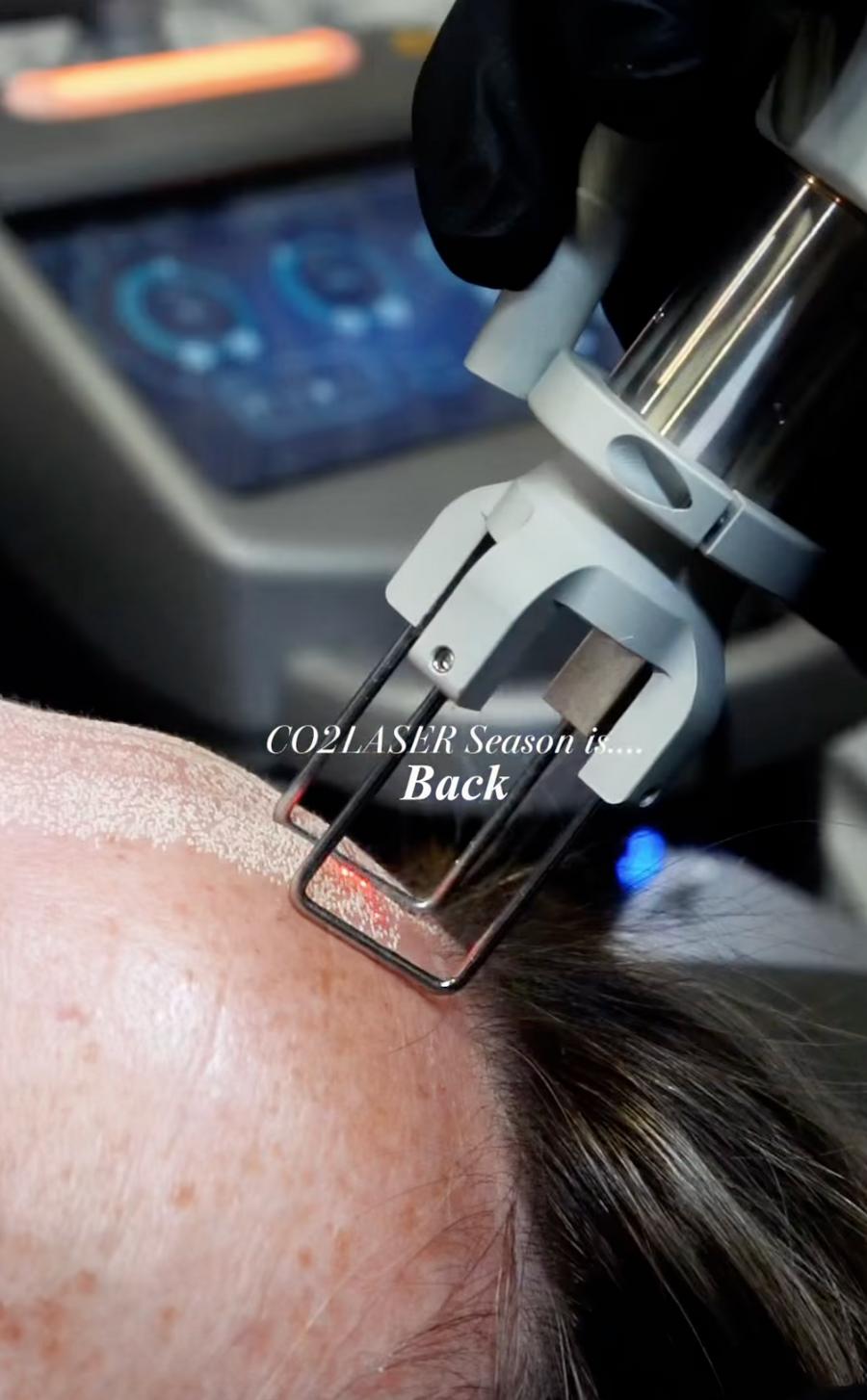 CO2 Laser