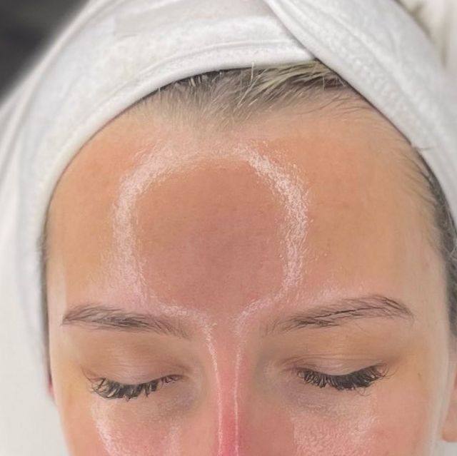 Microneedling